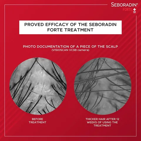 Hair Strengthening and Nourishing Lotion Prevents Hair Loss by Seboradin 200 ml