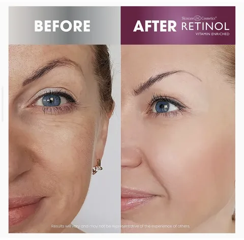 Retinol Anti-Aging Skincare Set by SkinCare Cosmetics